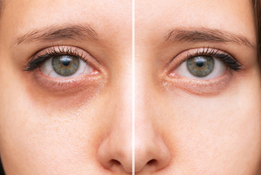 Know About Dark Circles 