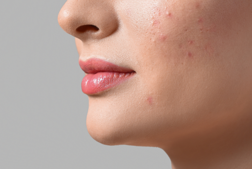 ‘Non-Comedogenic’ skincare Products? Explore more.